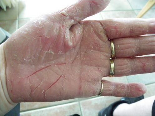 Le psoriasis au creux de la main
