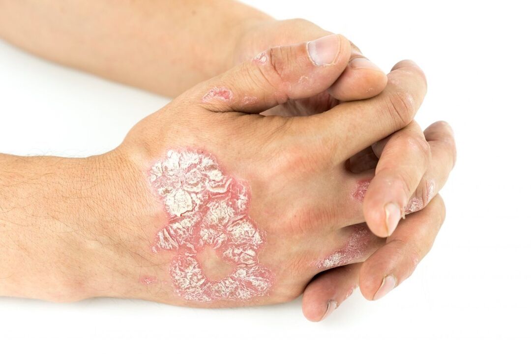 À quoi ressemble le psoriasis sur les mains