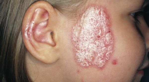 Plaque de psoriasis sur le visage