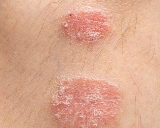 Apparence des plaques de psoriasis