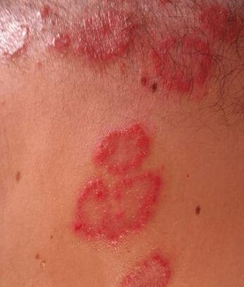 Spots psoriasis