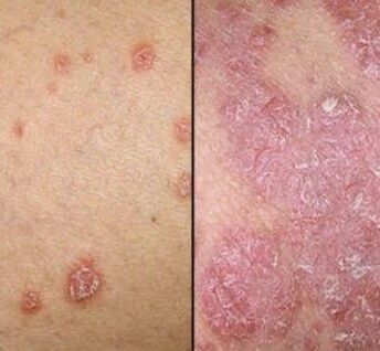 Plaques de psoriasis