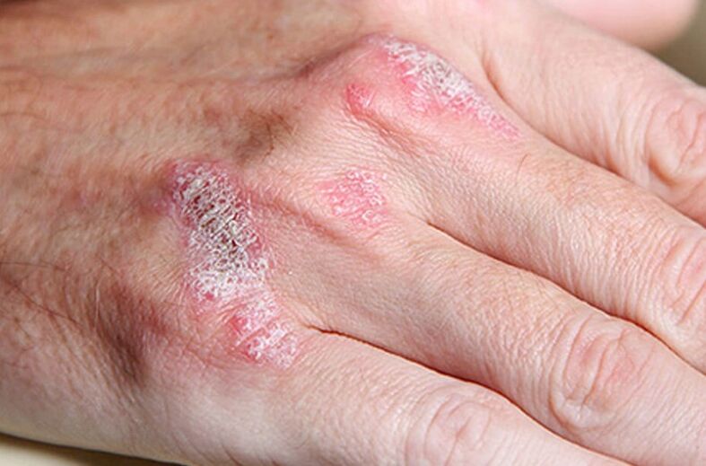 Besoins la ladomarly du psoriasis