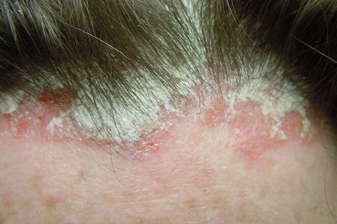 Le psoriasis capture toute la partie velue de la tête