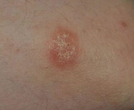 Spot psoriasis