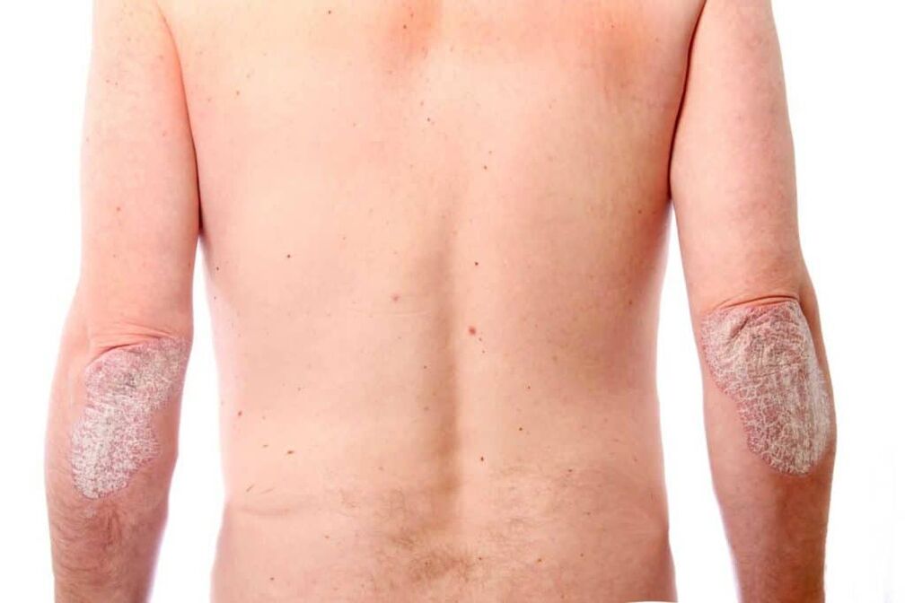 La deuxième étape du psoriasis