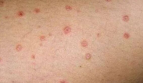 La phase initiale du psoriasis