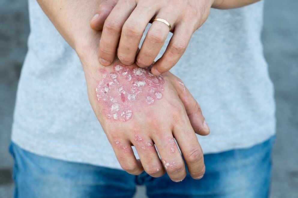 Le psoriasis est