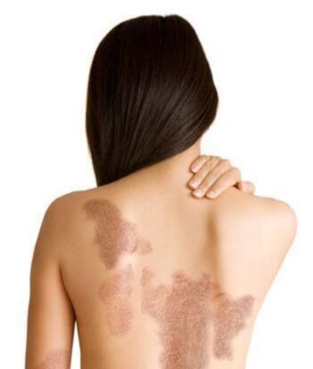 Étapes du psoriasis en fonction de la zone de la lésion