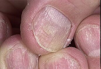 Psoriasis des ongles
