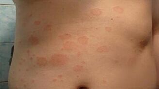 Psoriasis sur l'estomac