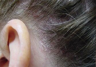 Psoriasis sur la tête