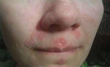 Psoriasis sur le visage