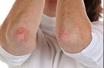 Psoriasis sur les coudes