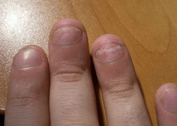 Psoriasis des ongles