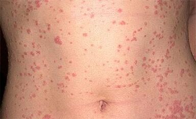 Psoriasis sur le corps