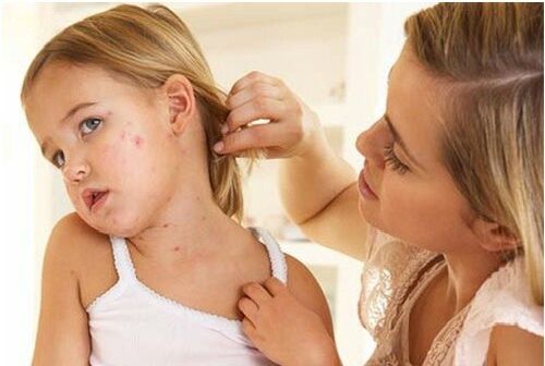Photo de la phase initiale du psoriasis