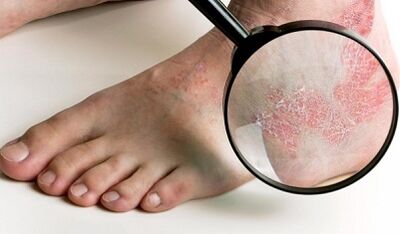 Façons de traiter le psoriasis