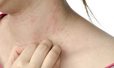 Traitement du psoriasis avancé
