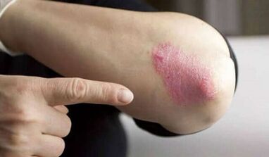 stade stationnaire du développement du psoriasis