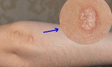 Étapes de développement du psoriasis