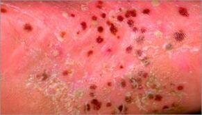 Psoriasis pustuleux
