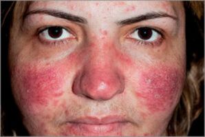 Psoriasis séborrhéique