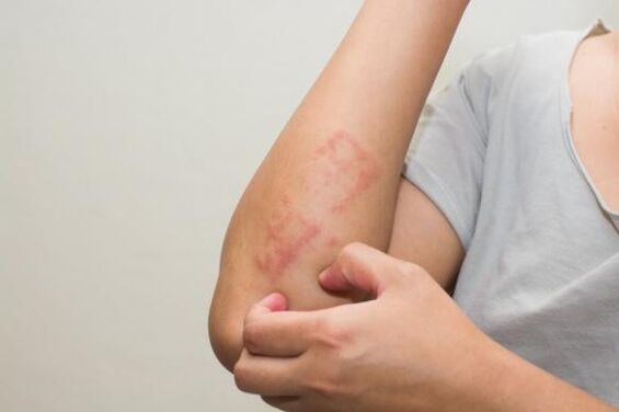 Les dernières méthodes de traitement du psoriasis