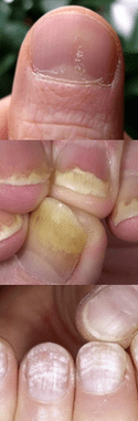 Psoriasis de clou - étapes initiales