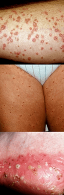 Psoriasis sur les pieds