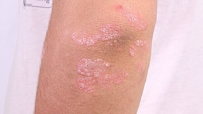Photo d'un psoriasis à un stade précoce