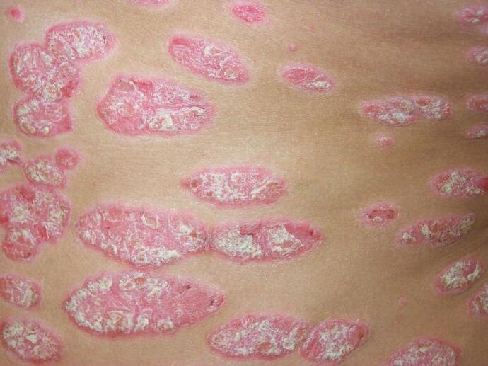 Psoriasis en plaques