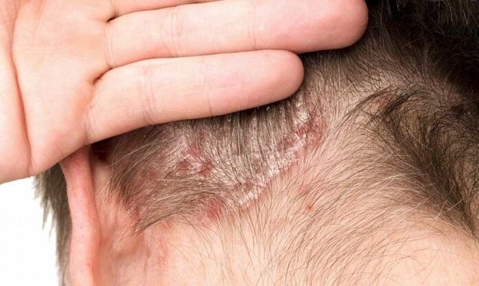 Psoriasis sur la tête
