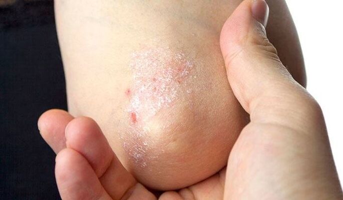 Symptômes du psoriasis aux premiers stades