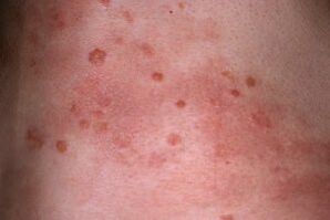 Photo du psoriasis sur la peau